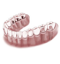 supported_bridges 5 molar implants