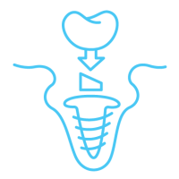 CVOS icons 2Implant Placement CVOS icons 2Implant Placement