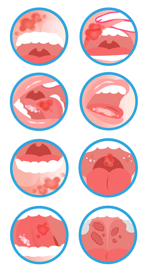 Oral-Disease-infographic-500pxW